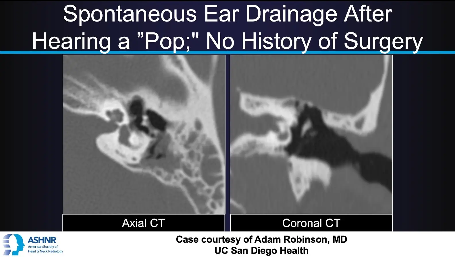 Axial and coronal CT scans of the temporal bone demonstrating abnormal middle ear structures in a patient with spontaneous ear drainage and no surgery history. Case courtesy of Adam Robinson, MD, UC San Diego Health
