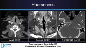 Axial, coronal, and bone-window CT images showing upper airway anatomy in a patient presenting with hoarseness. By Dr. Remy Lobo, University of Michigan & University of Utah.