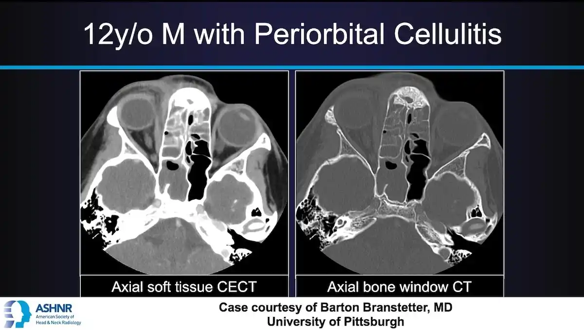 Axial CT scans showing orbital inflammation and ethmoid sinus opacification in a pediatric patient with periorbital cellulitis.