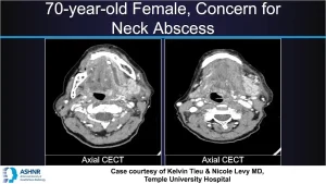 Axial contrast-enhanced CT scans of the neck showing asymmetric submandibular gland swelling in a patient with concern for neck abscess.