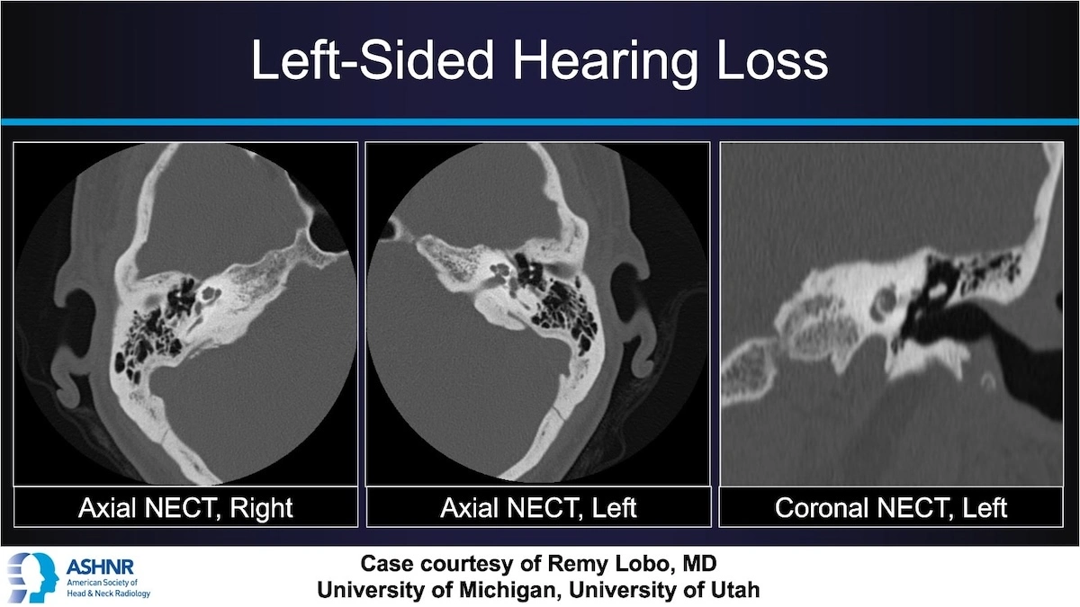 Axial and coronal CT images of the temporal bone comparing normal right ear with left-sided abnormal lucency near the oval window.