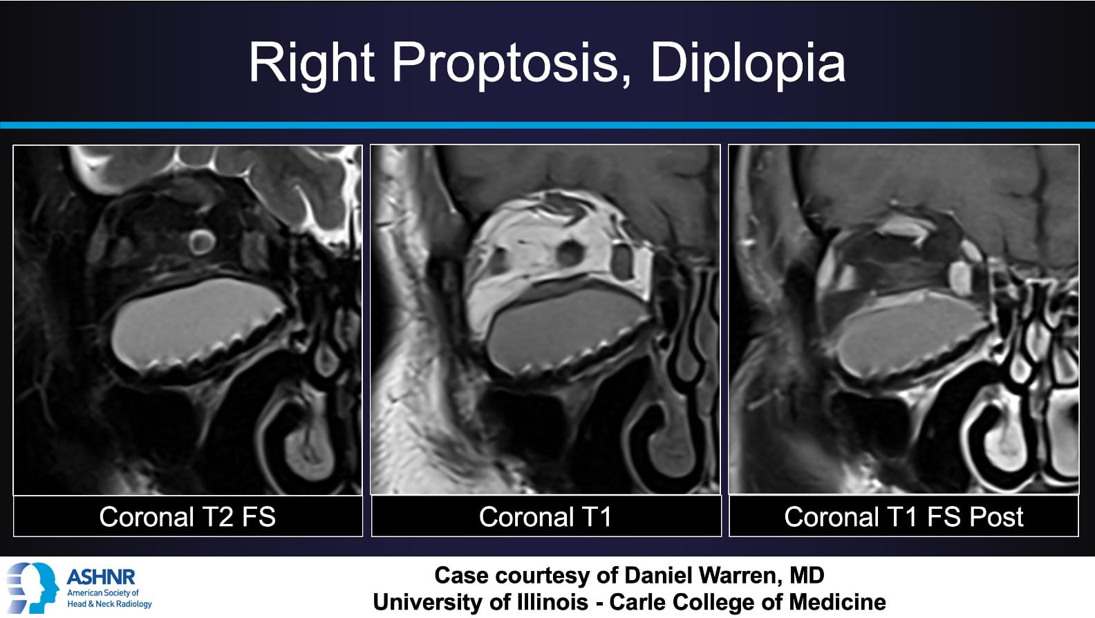 Coronal T2 FS, T1, and T1 post-contrast fat-saturated MRI of the right orbit demonstrating a dome-shaped T2 hyperintense cystic lesion with thin peripheral enhancement and susceptibility artifact from a titanium orbital floor plate, consistent with post-traumatic mucocele.