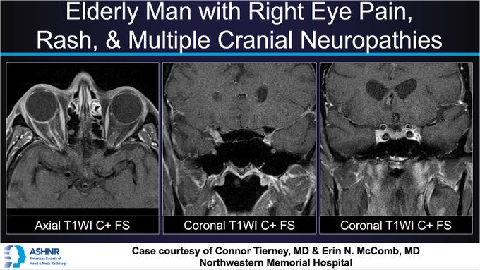 Orbital MRI in herpes zoster ophthalmicus with right eye pain and cranial neuropathies. By Connor Tierney, MD & Erin N. McComb, MD, NMH.
