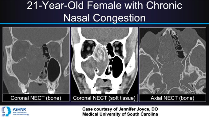 Sinus NECT in allergic fungal rhinosinusitis presenting as chronic nasal congestion. By Jennifer Joyce, DO, Medical University of South Carolina.