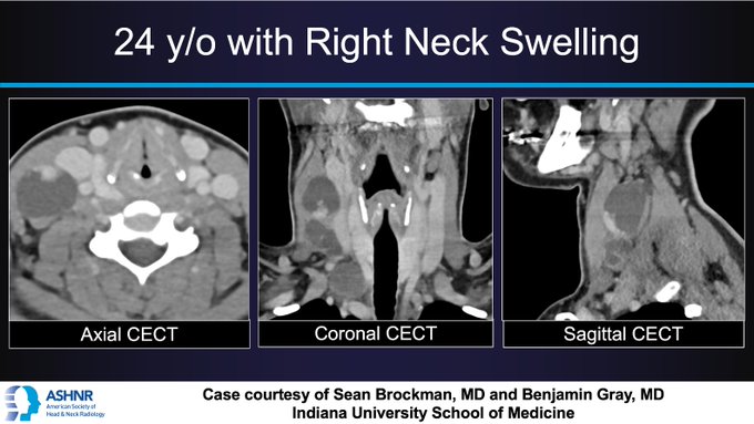 Neck CECT in papillary thyroid carcinoma with cystic cervical adenopathy. By Sean Brockman, MD and Benjamin Gray, MD, Indiana University School of Medicine.